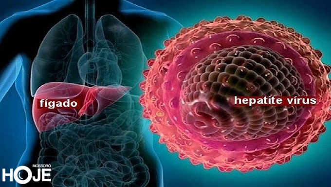 Imagem 1 -  Hepatite A: saiba como se pega o vírus, quais são os sintomas e tratamentos