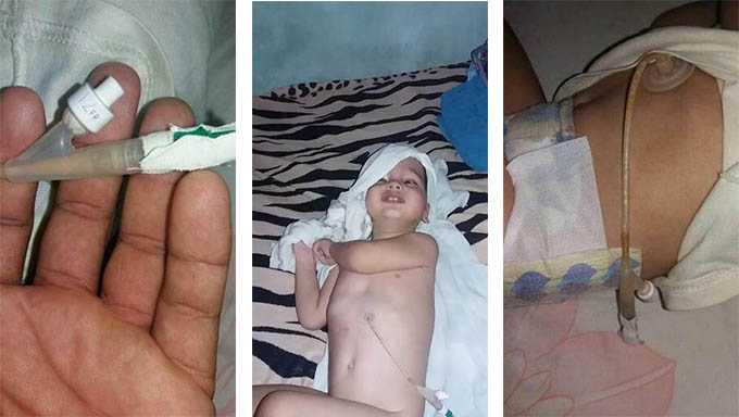   Imagens cedidas pela mãe de João Gabriel, de nome Daniele Alice, que pede ajuda para comprar a fórmula e substituir a sonda, que deveria ter sido substituída em novembro de 2018