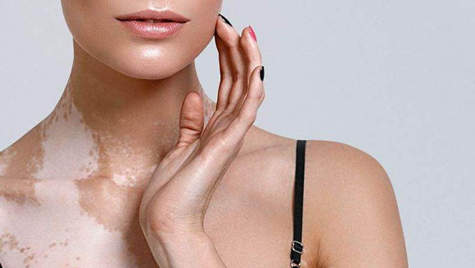   O tratamento para o vitiligo deve ser feito também, com o apoio de um psicólogo. 