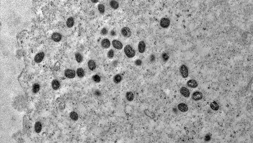 Imagem 1 -  SMS de Mossoró emite novo alerta sobre transmissão e prevenção à Varíola dos Macacos. A doença infectocontagiosa é causada pelo vírus Monkepypox (PPXV). Apesar de ser chamada de varíola dos macacos, ela não é transmitida por esse animal. Os sintomas mais comuns são febre de início súbito, aparecimento de lesões na pele (pode ser única ou várias), aparecimento de linfonodos (íngua), dores no corpo e fraqueza profunda. Os modos de transmissão são: por meio de contato próximo/íntimo com uma pessoa doente (infectada pelo vírus Monkeypox) e com lesões de pele.