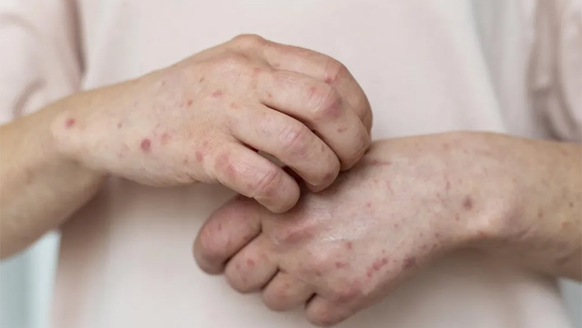 Imagem 1 -  Dos 102 casos confirmados no Rio Grande do Norte, 84 são homens e 18, mulheres. Segundo a Sesap, Natal concentra a maioria dos casos, com 64 pessoas diagnosticadas com a doença. Em seguida aparecem as cidades de Parnamirim (16) e Extremoz (4). No Rio Grande do Norte, o primeiro caso de varíola dos macacos foi confirmado no dia 1º de julho.  Em agosto o governo do estado lançou um plano de contingência para prevenção e combate à disseminação da doença.