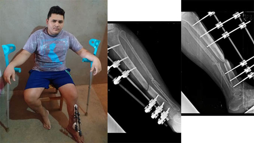 Imagem 1 -  Na prática, o que ocorreu é que o HRTM, após fazer o primeiro atendimento, mandou Natanael Costa para casa, aguardar ser chamado para fazer a cirurgia eletiva, ou seja, retirada do fixador e colocado as placas na fibula e tíbia quebrados no acidente.  Só que esqueceu. Agora, a esposa de Natanael, Fernanda Costa, cansada de esperar, pediu ajuda na Secretaria Municipal de Saúde. Natanael foi incluído Central de Regulação para fazer a cirurgia pelo SUS, só que ela ou ele não tem qualquer noção de quando isto vai acontecer. 