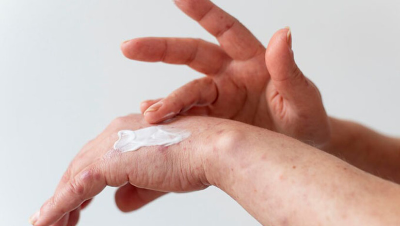 Imagem 1 -  Cerca de 3.500 casos de câncer de pele não melanoma serão registrados no Rio Grande do Norte até o final de 2023. O dado divulgado recentemente pelo Instituto Nacional do Câncer (INCA) chama a atenção para a doença justamente na estação do ano na qual a exposição ao sol é mais frequente entre os potiguares.