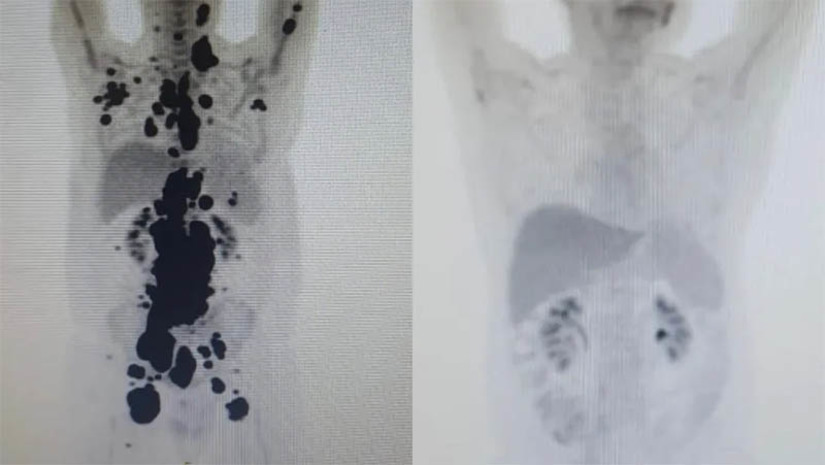 Imagem 1 - CAR-T pode poupar recursos e melhorar a qualidade de vida de pacientes com câncer. O tratamento inovador contra a doença está em desenvolvimento pelo Instituto Butantan. No Brasil, o SUS gasta cerca de R$ 3 bilhões por ano com o tratamento de pacientes oncológicos. A inclusão da terapia celular CAR-T na saúde pública, além de proporcionar uma maior chance de cura aos pacientes, poderá reduzir a necessidade de tratamentos convencionais, poupando recursos e melhorando a qualidade de vida das pessoas. Até agora, 14 pacientes foram tratados com o CAR-T Cell no país, com verbas da Fapesp e do CNPq. Todos tiveram remissão de ao menos 60% dos tumores. Um deles é Paulo Peregrino, de 61 anos, que lutava contra o câncer havia 13 anos e estava prestes a receber cuidados paliativos quando foi submetido ao tratamento em abril e, em apenas um mês, teve remissão completa do seu linfoma. Ele recebeu alta no domingo (28). Imagem 1 - CAR-T pode poupar recursos e melhorar a qualidade de vida de pacientes com câncer. O tratamento inovador contra a doença está em desenvolvimento pelo Instituto Butantan. No Brasil, o SUS gasta cerca de R$ 3 bilhões por ano com o tratamento de pacientes oncológicos. A inclusão da terapia celular CAR-T na saúde pública, além de proporcionar uma maior chance de cura aos pacientes, poderá reduzir a necessidade de tratamentos convencionais, poupando recursos e melhorando a qualidade de vida das pessoas. Até agora, 14 pacientes foram tratados com o CAR-T Cell no país, com verbas da Fapesp e do CNPq. Todos tiveram remissão de ao menos 60% dos tumores. Um deles é Paulo Peregrino, de 61 anos, que lutava contra o câncer havia 13 anos e estava prestes a receber cuidados paliativos quando foi submetido ao tratamento em abril e, em apenas um mês, teve remissão completa do seu linfoma. Ele recebeu alta no domingo (28).