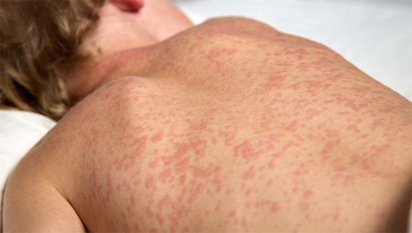 Imagem 1 -  Pelos próximos dez dias a orientação é reforçar a atenção diária nos serviços de saúde para a identificação de sinais e sintomas das doenças, a fim de confirmar ou descartar os casos, assim como notificar todas as ações, dados esses que norteiam as possíveis ações da Sesap, podendo conter surtos e mantendo a interrupção da circulação do vírus do sarampo, além de certificar a ausência de circulação do vírus e manutenção da eliminação da rubéola.