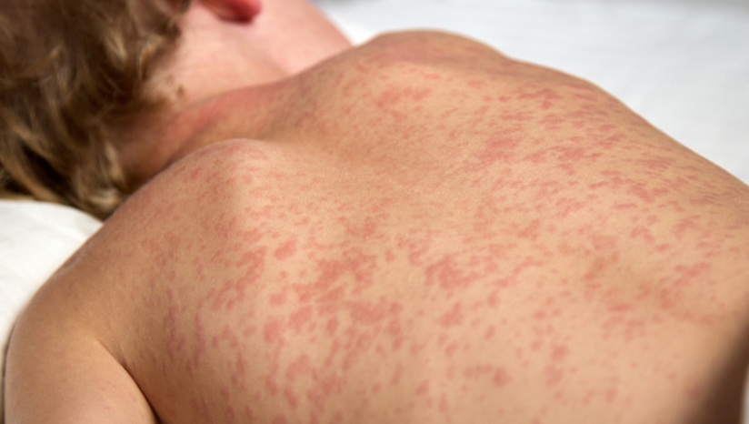 Imagem 1 -  Rio Grande do Norte não registra casos de sarampo há quatro anos. Na quarta-feira (5), o Brasil completou dois anos sem casos autóctones da doença (quando a contaminação aconteceu no local onde o caso foi registrado), aproximando-se assim da retomada da certificação de 'país livre de sarampo', após ter deixado de ser considerado uma região endêmica no ano passado. No RN, não há registro de casos da doença desde o ano de 2020. 