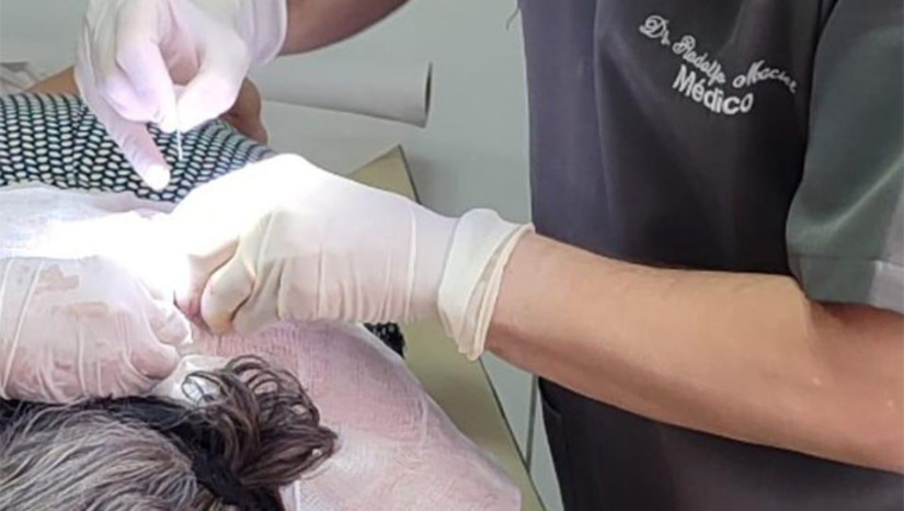 Imagem 1 - A ação prestou atendimento especializado a 22 pacientes, resultando na remoção segura de mais de 50 lesões de pele e garantindo que os cidadãos recebessem o cuidado necessário dentro do próprio município. O serviço elimina a necessidade de deslocamento para cidades vizinhas, garantindo acesso rápido a procedimentos essenciais. O mutirão possui impacto direto na saúde preventiva, pois as cirurgias são vitais para a descoberta precoce e a prevenção do avanço de doenças, como o câncer de pele. Imagem 1 - A ação prestou atendimento especializado a 22 pacientes, resultando na remoção segura de mais de 50 lesões de pele e garantindo que os cidadãos recebessem o cuidado necessário dentro do próprio município. O serviço elimina a necessidade de deslocamento para cidades vizinhas, garantindo acesso rápido a procedimentos essenciais. O mutirão possui impacto direto na saúde preventiva, pois as cirurgias são vitais para a descoberta precoce e a prevenção do avanço de doenças, como o câncer de pele.